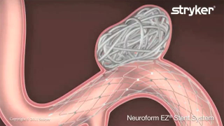 Illustration for article titled What Is Coil Embolization?
